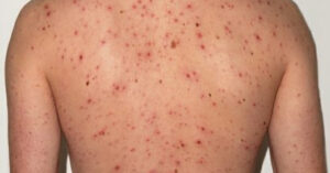 मलङ्गवामा दादुरा सङ्क्रमण फैलियो