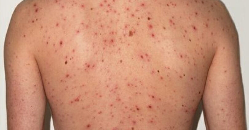 मलङ्गवामा दादुरा सङ्क्रमण फैलियो